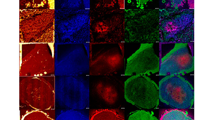 Hypoxia-driven-signaling-pathways-in-breast-cancer