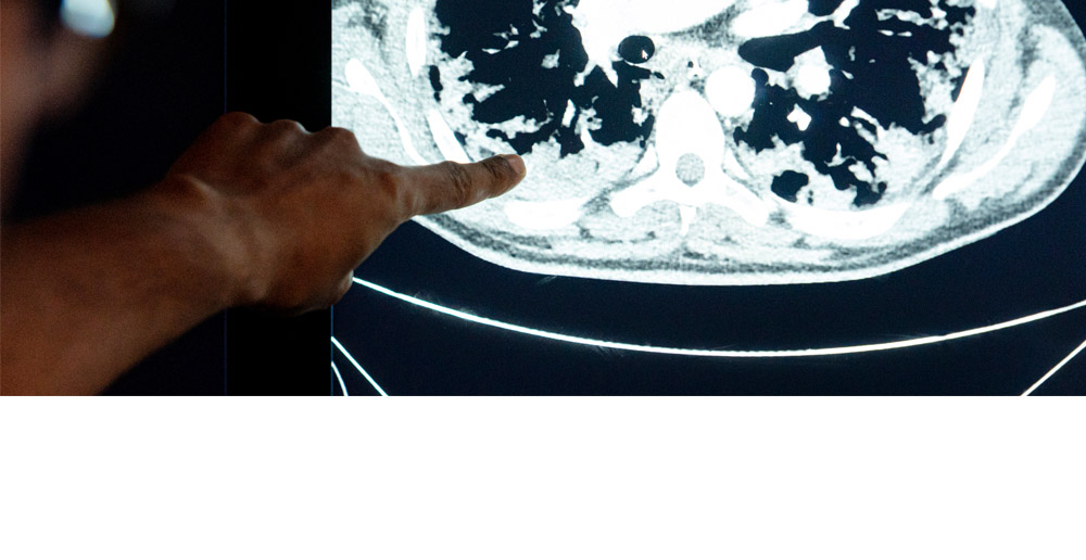 Researcher points out lung damage on mri scan