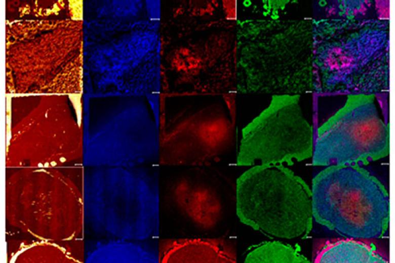 Hypoxia-driven-signaling-pathways-in-breast-cancer